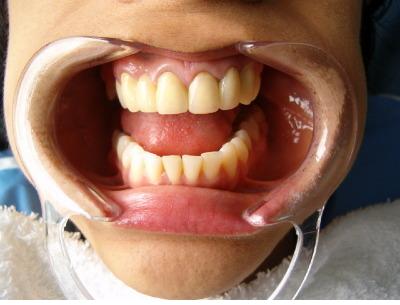 Elaboración de coronas en la Academia Americana de técnicoa Dentales, Carrera Técnica Dental, Prótesis Dental