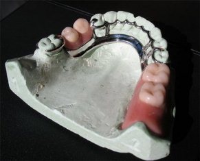 Protesis dental parcial removible